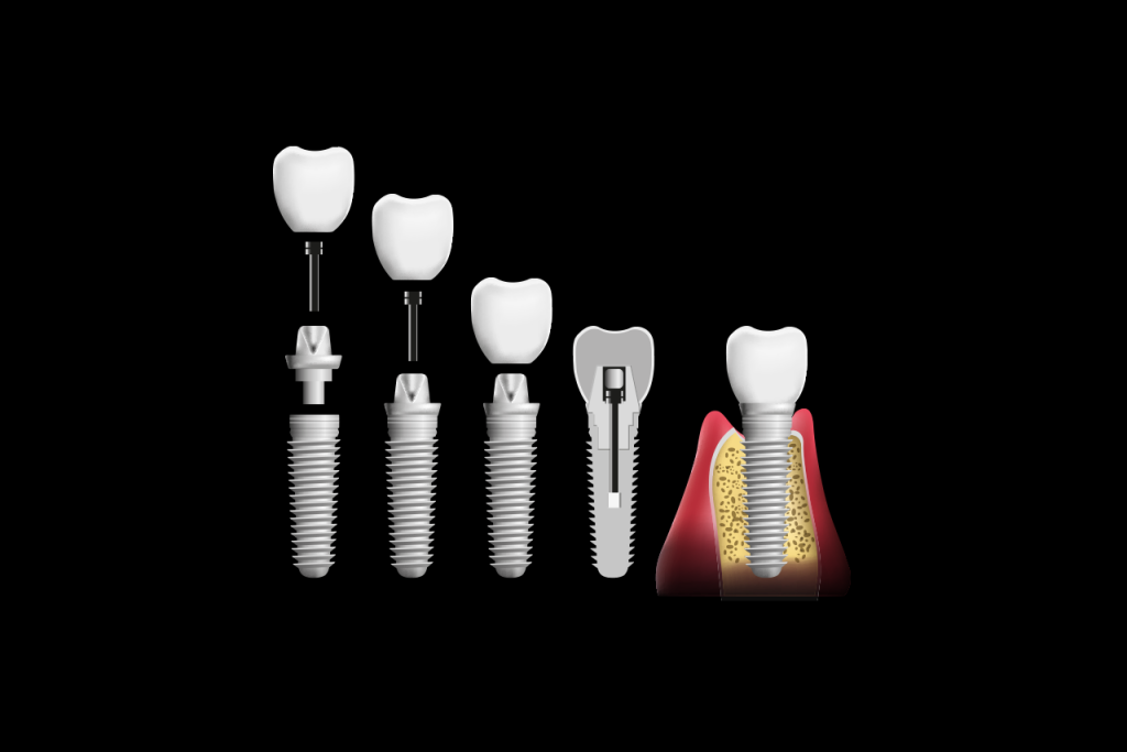 Atakent Diş İmplantı: İstanbul’da Eksik Diş Çözümü